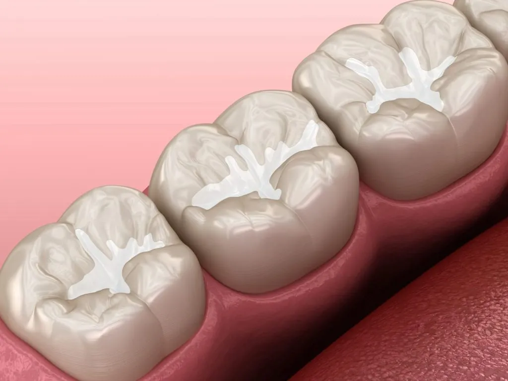 Dental Sealants 