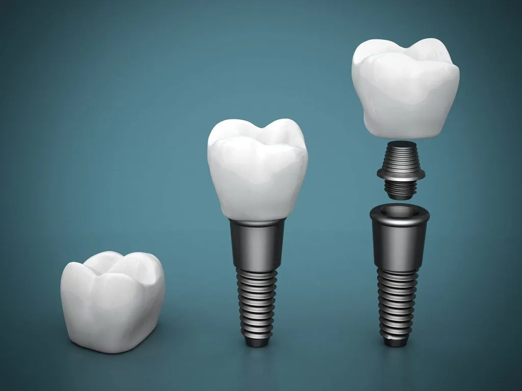 Dental Implants
