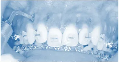 accelerated orthodontics london b2